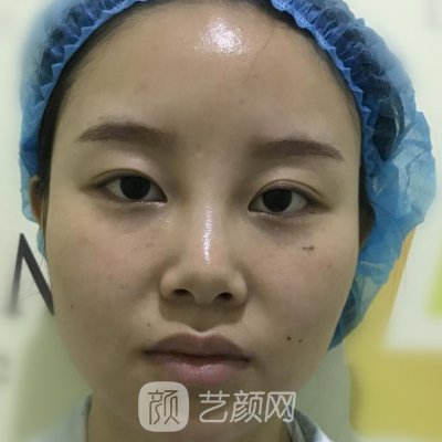 长沙付腾鹏医生做鼻子自然吗?医生招牌实例曝光