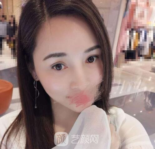 沈阳杏林整形双眼皮失败修复实例，再也不用花两次钱遭两次罪