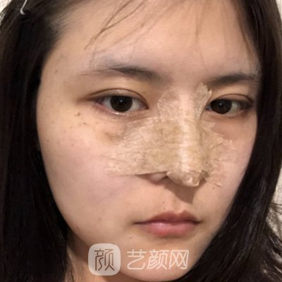 西安丁合军做鼻子怎么样？90天亲测实例公布